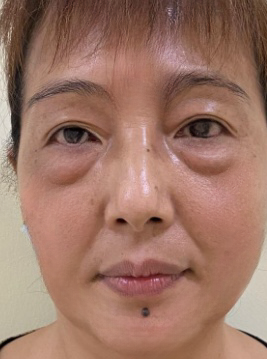去眼袋手术