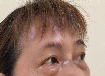 去眼袋手术