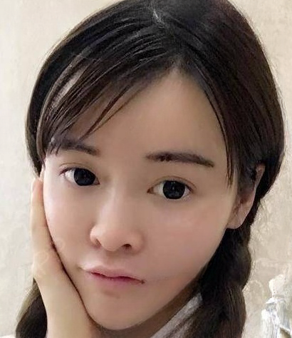 自体脂肪胶