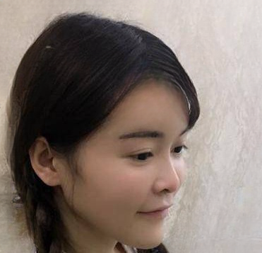 自体脂肪胶