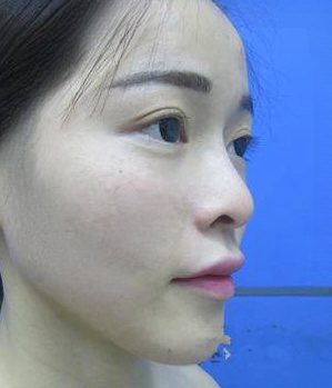 自体脂肪胶