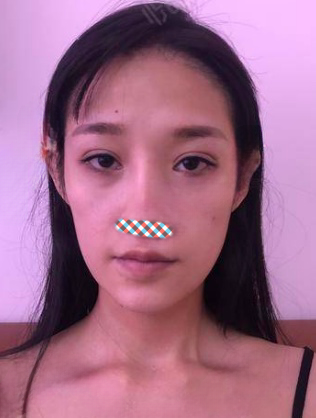 自体脂肪胶