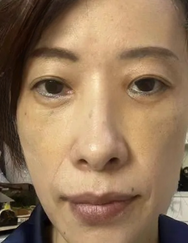 去眼袋手术
