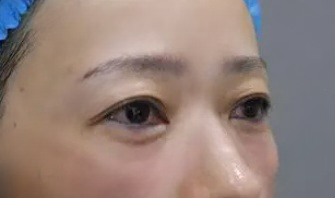 去眼袋手术