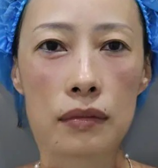 去眼袋手术