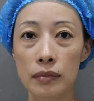 去眼袋手术