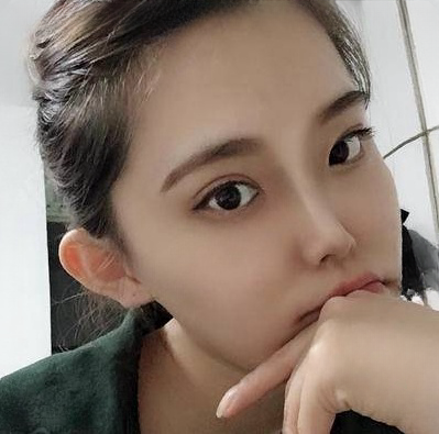 自体脂肪胶