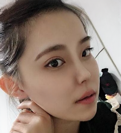 自体脂肪胶