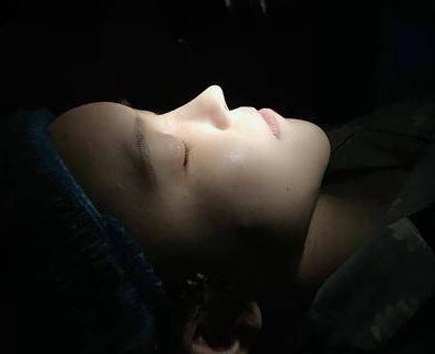自体脂肪胶