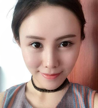 自体脂肪胶