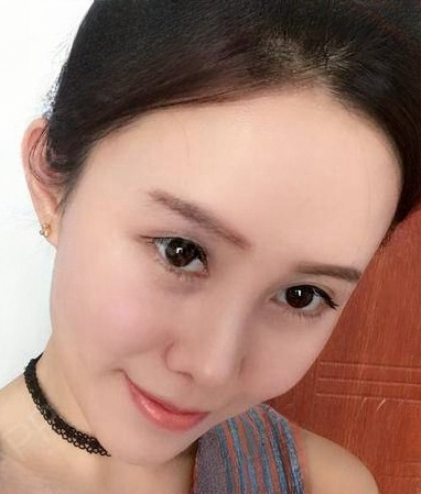 自体脂肪胶