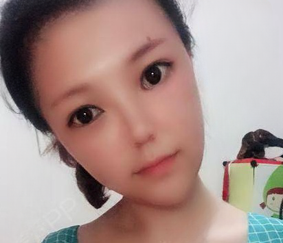 自体脂肪胶