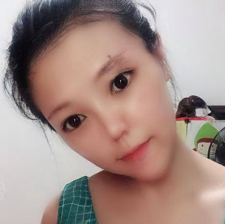 自体脂肪胶