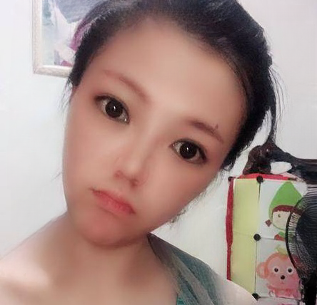 自体脂肪胶