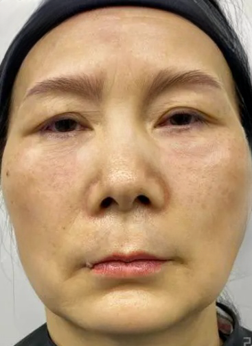去眼袋手术