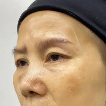 去眼袋手术