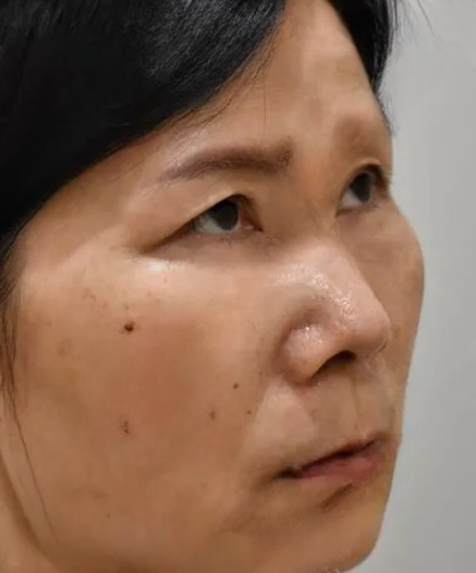 去眼袋手术
