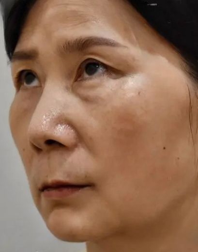 去眼袋手术