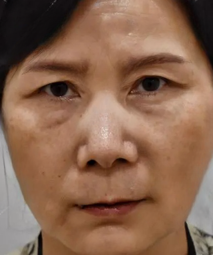 去眼袋手术