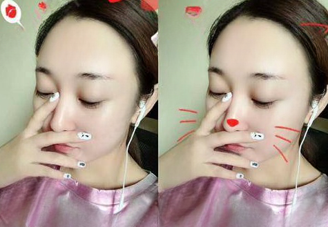 自体脂肪胶