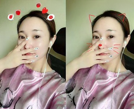 自体脂肪胶