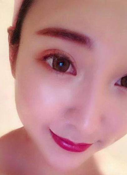 自体脂肪胶