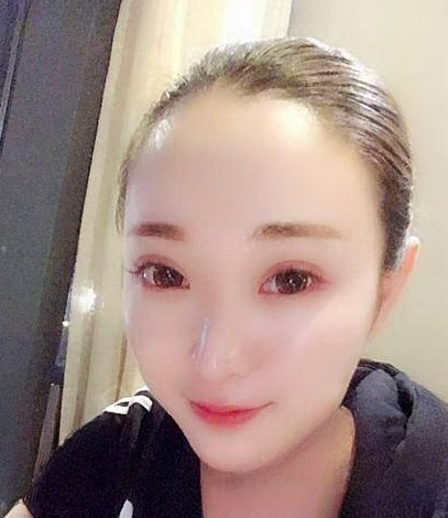 自体脂肪胶