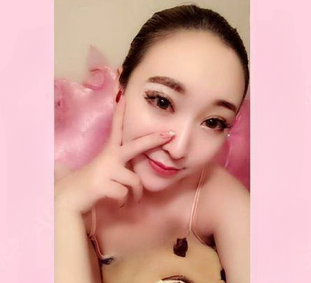 自体脂肪胶