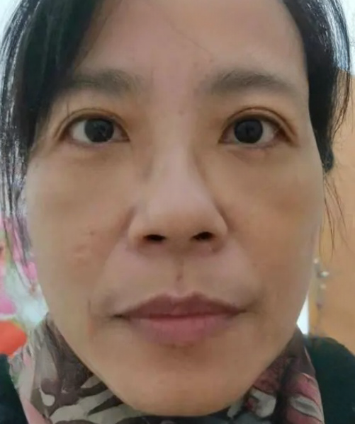 去眼袋手术