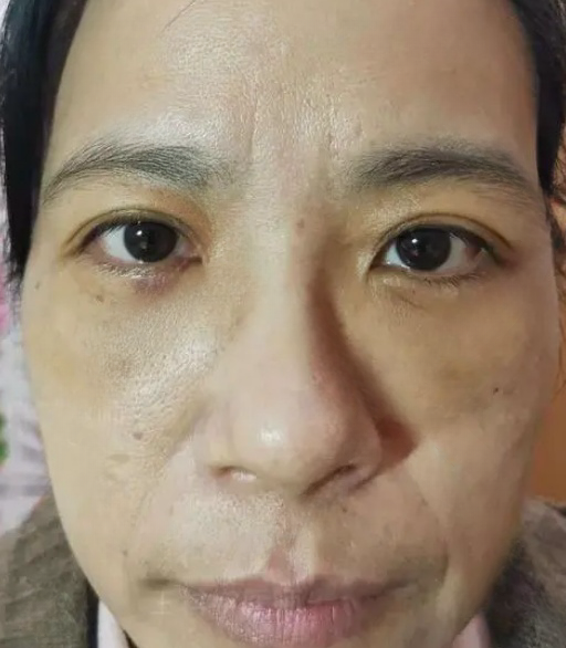 去眼袋手术