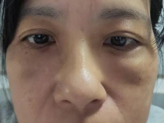 去眼袋手术