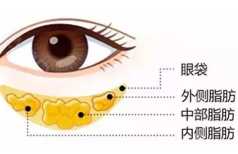 去眼袋手术
