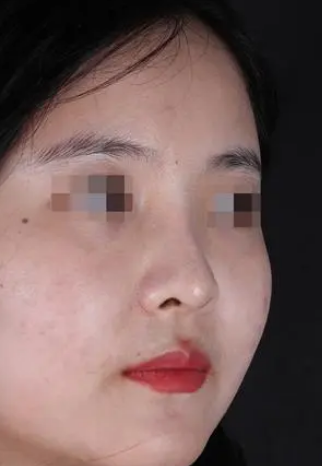 隆鼻手术