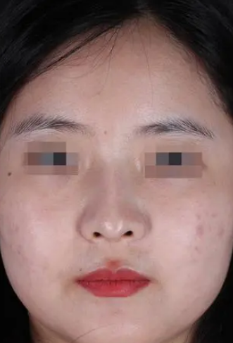 隆鼻手术