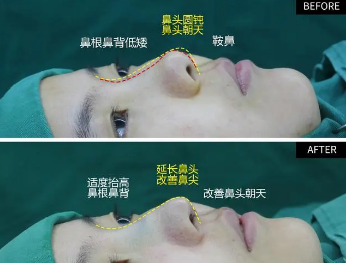 隆鼻手术