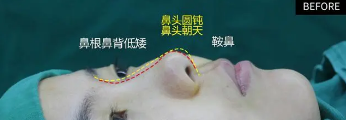 隆鼻手术