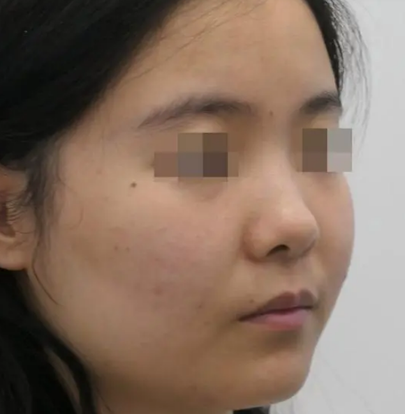 隆鼻手术