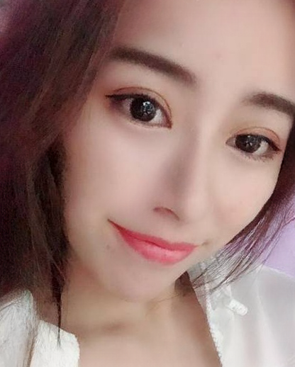 双眼皮手术