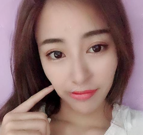 双眼皮手术