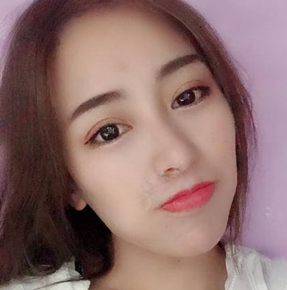 双眼皮手术
