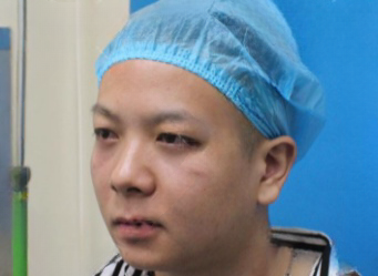 去眼袋手术