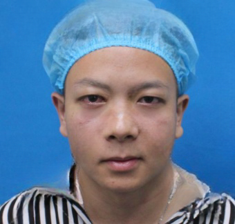 去眼袋手术