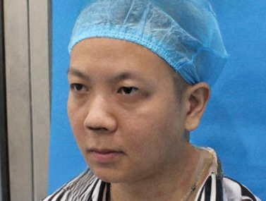 去眼袋手术