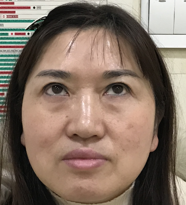 去眼袋手术