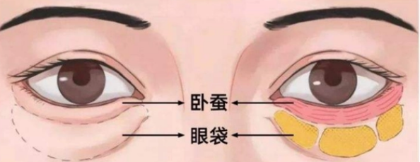 去眼袋手术