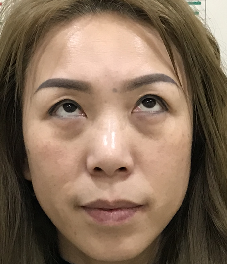 去眼袋手术