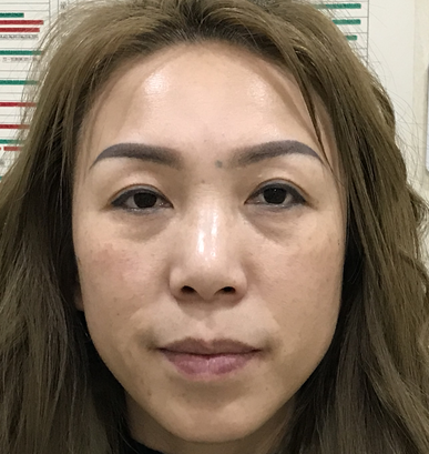 去眼袋手术