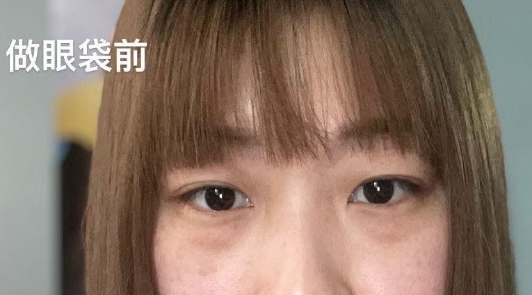 去眼袋手术