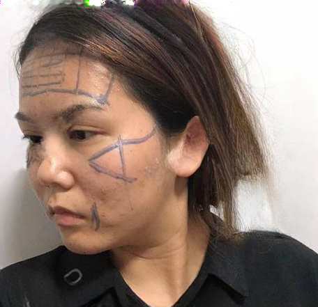 自体脂肪胶