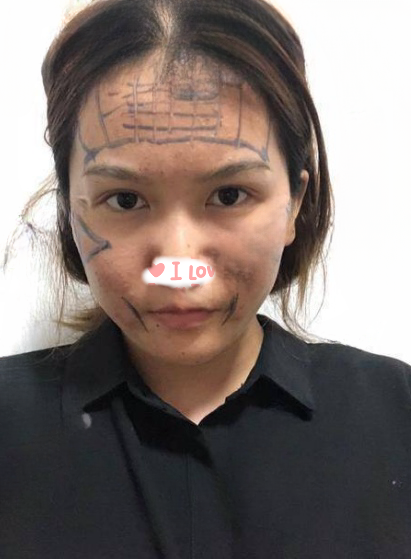 自体脂肪胶